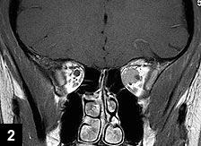 Figure 2: Coronal MRI scan revealing homogenous optic nerve sheath mass