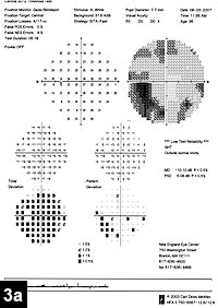 Figure 3a: Left eye visual fields at the time of presentation and 4 months after radiation therapy