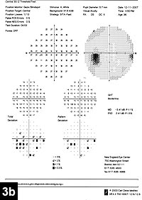 Figure 3b: Left eye visual fields at the time of presentation and 4 months after radiation therapy