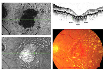 Fundus autofluorescence image