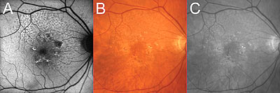 An elderly woman presented with choroidal neovascularization in the left eye and soft drusen in the right eye