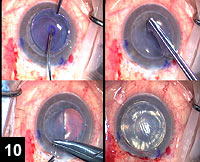 Figure 10: A small amount of Healon is placed on the central endothelial surface of the donor corneal graft