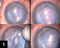 Figure 1: Intraoperative view of a failed PK graft and a well-adherent, failed DXEK graft with bullous keratopathy and distorted corneal light reflex