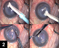 Figure 2: Loosely adherent, edematous corneal epithelium is removed by using dry Weck-Cel sponges in a to-and-fro windshield wiper motion