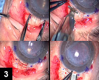 Figure 3: After complete hemostasis of the temporal scleral region, an inked caliper is used to mark a chord length of 5 mm close to the surgical limbus