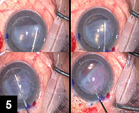 Figure 5: The reverse Sinskey hook is moved to the right and left to gently define and release the distal margins of the well-adherent donor disc from the previous PK graft