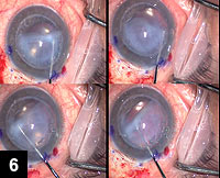 Figure 6: The donor corneal disc is gently released from the host cornea, namely the PK graft