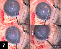 Figure 7: The reverse Sinskey hook is introduced within the donor-recipient interface, and it is moved to the right and left in a windshield wiper-type of motion to assist in the release of the donor corneal disc from the recipient failed PK graft