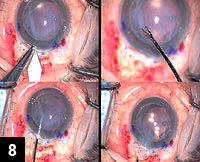 Figure 8: The anterior chamber is entered using a 3.2-mm keratome blade