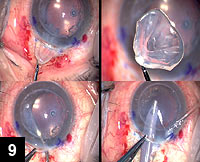 Figure 9: Removal of the failed donor corneal disc using the John Super-Microforceps 