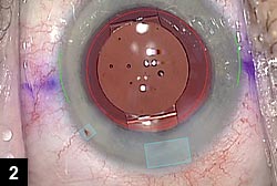 Figure 2: The dashed red line indicates a 6.5-mm capsulorrhexis, which allows the 5-mm optic and the IOL hinges to be unobstructed