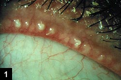 Figure 1: Pro-inflammatory cytokines have increased contact with the cornea in eyes from punctal plugs