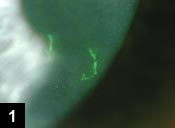 Figure 1: Color photograph of the left eye 6 weeks after initial presentation, showing presence of a pseudodendrite highlighted with fluorescein stain