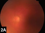 Figure 2A: Color fundus photograph of the left eye 2 months after discontinuation of oral acyclovir, demonstrating dense vitritis