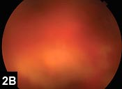 Figure 2B: Color photograph of the inferotemporal retina of the left eye, showing a discrete area of retinitis