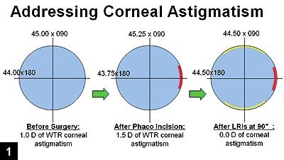 Figure 1: Before surgery, the patient has 1 D of with-the-rule corneal astigmatism