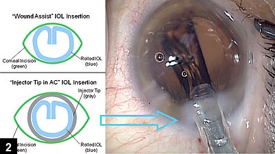 Figure 2: The wound-assist method allows a smaller corneal incision; however, there may be exposure to tear film contaminants