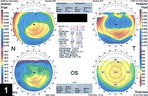 Figure 1: The Orbscan shows inferiorly displaced posterior float, minimal corneal thickening inferiorly and inferior corneal steepening