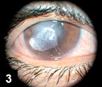 Figure 3: The nexy day the cornea perforated, and cyanoacrylate glue was applied