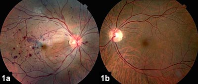 Figure 1: Fundus exam of the right eye (1a) and left eye (1b) demonstrates diffuse nerve fiber layer, intraretinal and subretinal hemorrhages, segmentation of the retinal vasculature and diffuse superficial retinal whitening