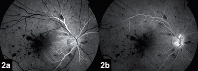 Figure 2: Fluorescein angiogram shows a marked delay in the central retinal artery filling at 0:39 (2a) with incomplete filling in the last frames of the angiogram at 5:16 (2b)