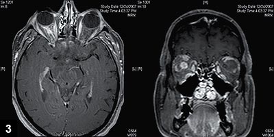 Figure 3: MRI of the brain and orbits demonstrated significant enhancement of the right optic nerve and nerve sheath on axial (3a) and coronal (3b) views