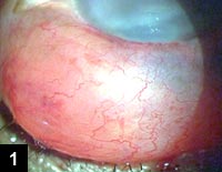 Figure 1: Phacocele. Note the subconjunctival swelling