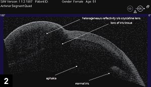 Figure 2: Anterior segment OCT showing the phacocele