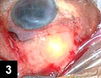 Figure 3: Conjunctiva explored, and the lens located and removed. Note the scleral laceration