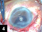 Figure 4: Fibrin glue-assisted sutureless posterior chamber IOL implantation