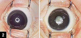 Figure 2: Left eye demonstrates poor pupillary dilation and dense cataract