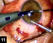 Figure 11: Coaxial microincision retinal forceps are used to drag the donor graft into the anterior chamber through a nasal clear-cornea incision with a bimanual pull-through maneuver