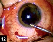 Figure 12: The donor tissue floats as a flat membrane inside the anterior chamber and does not require complex manipulation to unroll it