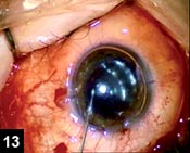 Figure 13: The recipient anterior chamber is air-filled after closing all of the corneal incisions with interrupted 10-0 nylon sutures