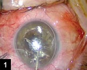 Figure 1: Intraoperative photograph