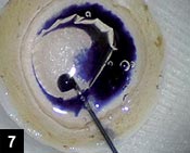 Figure 7: A few drops of trypan blue (Vision Blue, Dutch Ophthalmic Research Center) are injected into the air bubble created within the donor cornea