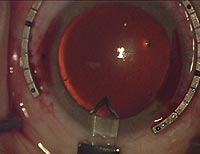 Temporal, single-plane clear corneal phaco wound completed