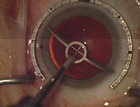 Nichamin fixation ring and gauge showing hash marks over central steep meridian, and two-cut ray marker delineating extent of arc to be incised