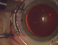 Inferior LRI begun, in peripheral most extent of clear corneal tissue