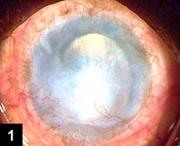 Figure 1: Pseudophakic bullous keratopathy with anterior chamber IOL