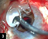 Figure 3: Explantation of the anterior chamber IOL