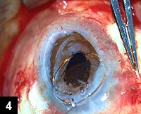 Figure 4: Glued posterior chamber  IOL being fixed