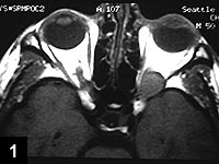 Figure 1: Non-contrast axial orbital MRI of a 50-year-old man with progressive vision loss in the left eye and a left relative afferent pupil defect, revealing a left orbital apex mass