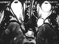 Figure 1: T1 is isointense with brain and T2 is bright, consistent with cavernous hemangioma