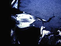 Figure 2: Sagittal views reveal far posterior location of mass, inferior to optic nerve