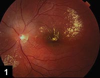 Figure 1: Elevated lesion on superior optic disc with accompanying peripapillary leakage and hard exudate