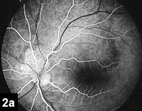 Figure 2a: Fluorescein angiography showing fine capillary filling within lesion.