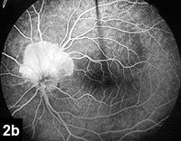 Figure 2b: Later fluorescein angiography frames with progressive hyperfluorescence and leakage.