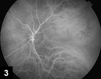 Figure 3: Fine capillary filling without early choroidal hyperfluorescence by indocyanine green angiography.