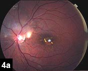 Figure 4a: Post-treatment resolution of edema and improvement of exudation. Fibrotic scar limiting vision